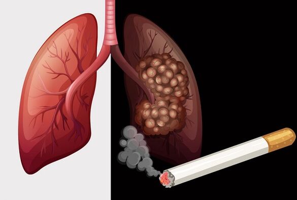pulmones del fumador y pulmones sanos