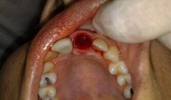 el lugar del diente extraído